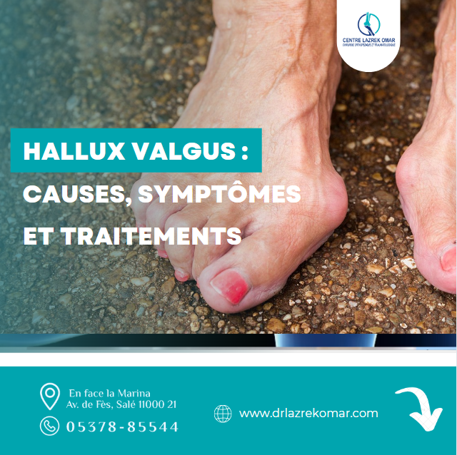 Hallux Valgus : Causes, Symptômes et Traitements