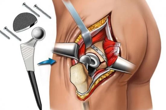 جراحة استبدال مفصل الورك: الأسباب والإجراءات وفترة التعافي
